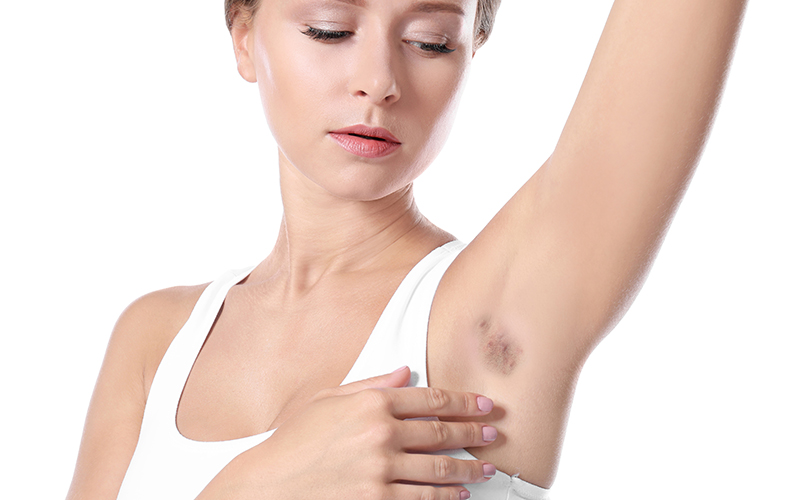 Hidradenitis Suppürativa 